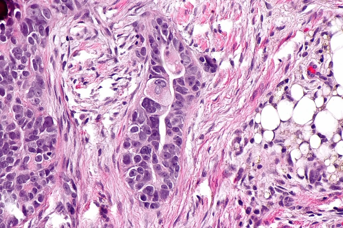 Peritonealkarzinose gynäkologischer Tumoren – Histologie & Zytologie: Histologie (HE): seröses Karzinom im Omentum – Tumorzellverbände infiltrieren desmoplastisches Stroma und Fettgewebe (rechts)