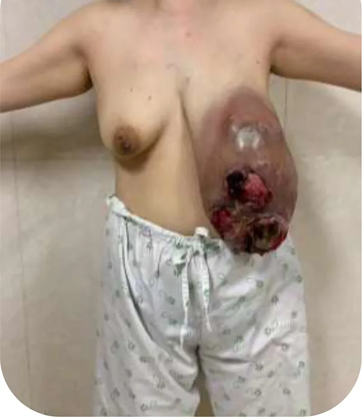 Phyllodes tumour – Endoscopy & gross