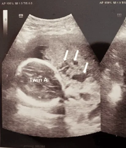 Placenta-accreta-Spektrum – Sonographie: Intraplazentare Lakunen bei Placenta praevia mit Accreta-Verdacht