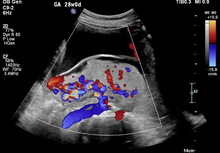 Placenta-accreta-Spektrum – Klinik: Plazentare Hypervaskularisation bei Placenta-accreta-Verdacht