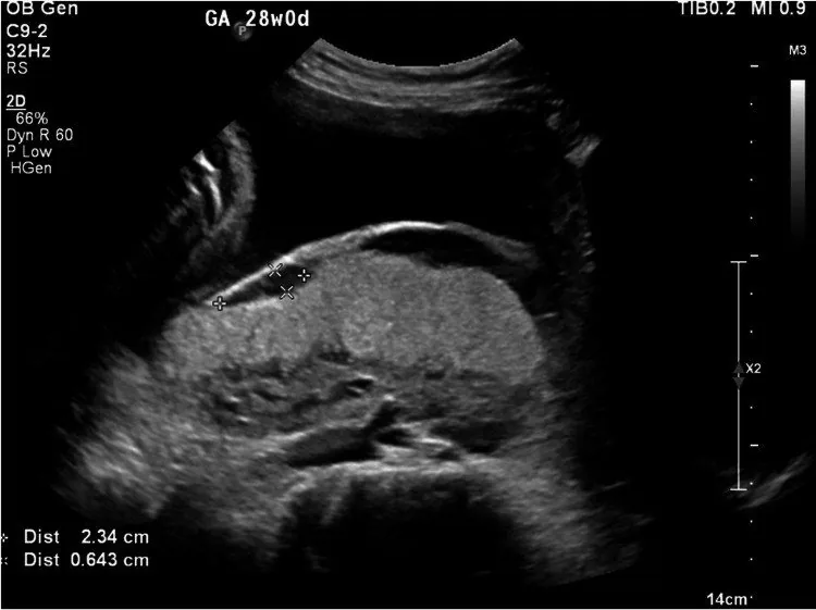 Placenta praevia – Sonographie: Placenta praevia totalis (28. SSW, posteriorer Sitz)
