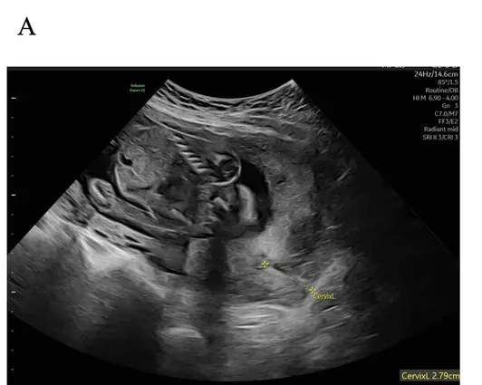 Placenta praevia – Sonographie: Placenta praevia totalis (20. SSW, transabdominal)