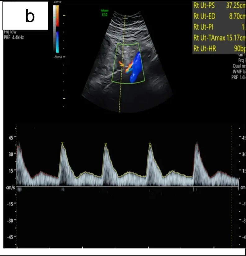 Plazentainsuffizienz – Sonographie: Normale A. uterina ohne Notch: vorwärtsgerichtete Kurve mit hohem diastolischem Fluss (Foto: Ackah JA, Mensah WS, Chen X, Dyer E, Chukwanugo UC, Ven Emery C, Akudjedu TN. (Archives of …