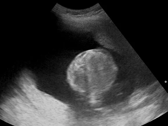 Polyhydramnios – Ultrasound