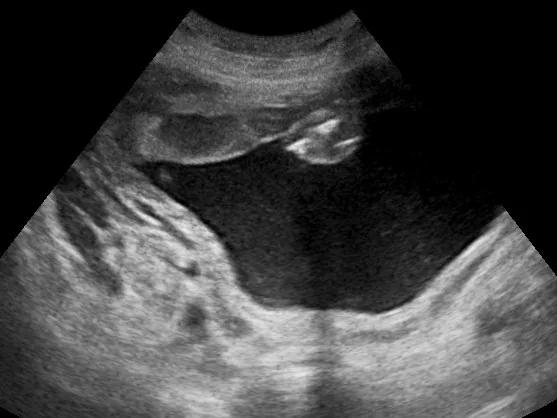 Polyhydramnios – Ultrasound