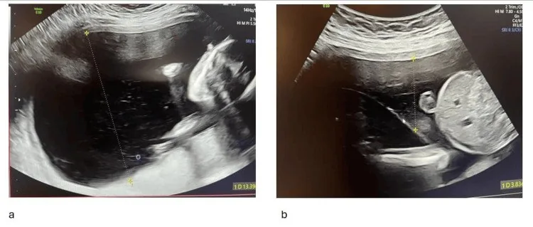 Polyhydramnios – Ultrasound