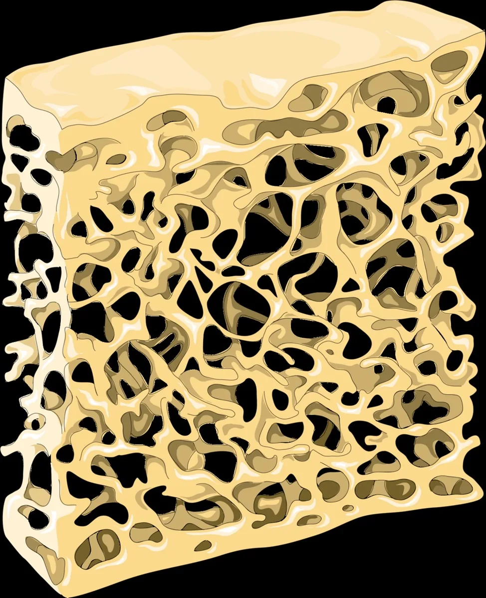 Postmenopausale Osteoporose – Schema: Schema: osteoporotische Spongiosa – ausgedünnte, teils unterbrochene Knochenbälkchen mit erweiterten Markräumen