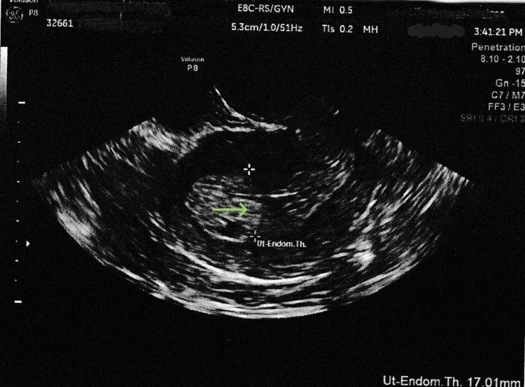 Postmenopausenblutung – Sonographie: Transvaginalsonographie: Endometrium 17 mm bei histologisch gesichertem Endometriumkarzinom
