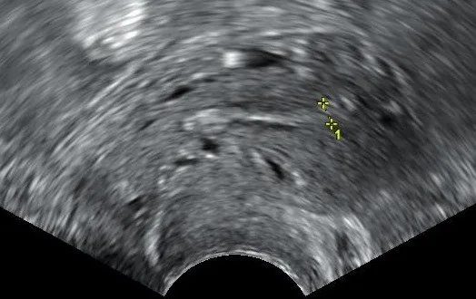 Postmenopausenblutung – Sonographie: Transvaginalsonographie bei Postmenopausenblutung: dünnes, atrophes Endometrium