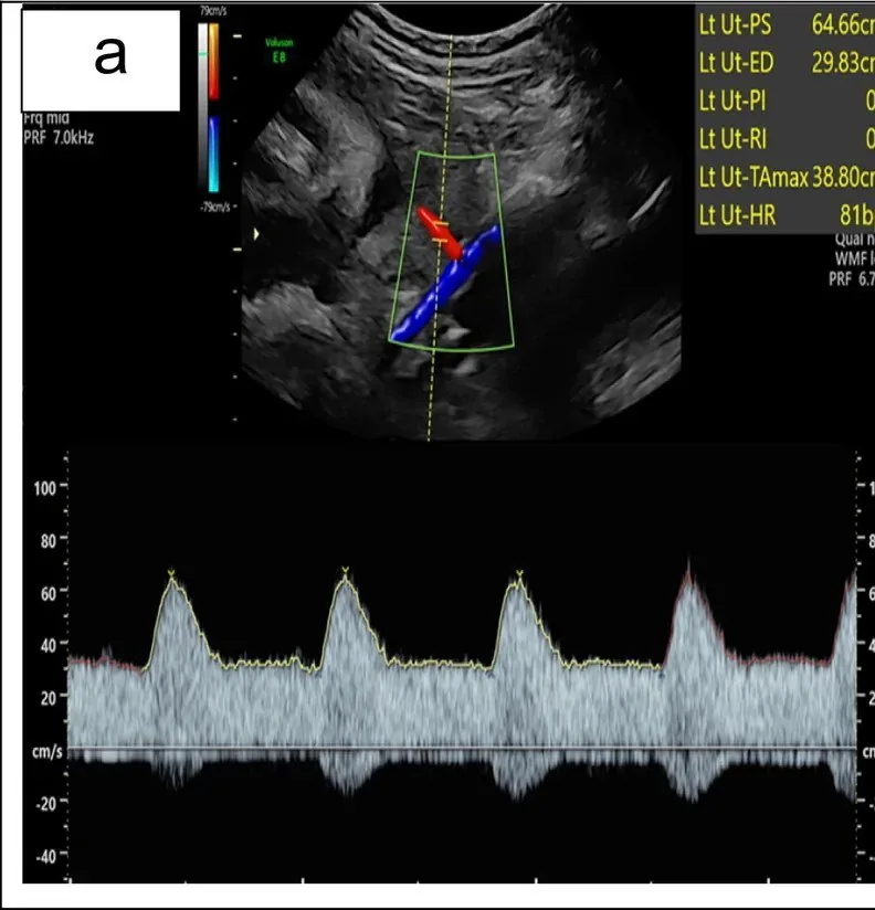 Pre-eclampsia – Ultrasound: A normal uterine artery without a notch: a forward waveform with high diastolic flow (Photo: Ackah JA, Mensah WS, Chen X, Dyer E, Chukwanugo UC, Ven Emery C, Akudjedu TN. (Archives of …