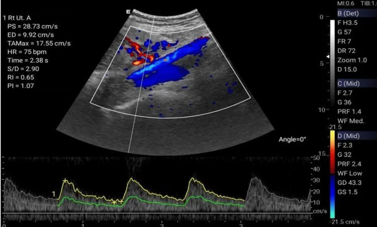 Pre-eclampsia – Ultrasound: Right uterine artery Doppler in pre-eclampsia with a pulsatility index of 1.07 (Photo: Godfrey MR, Atwiine F, Atukunda EC, Celi LA, Mwavu R, Kaggwa F, Haberer JE, Wasswa W. (Cureus, …