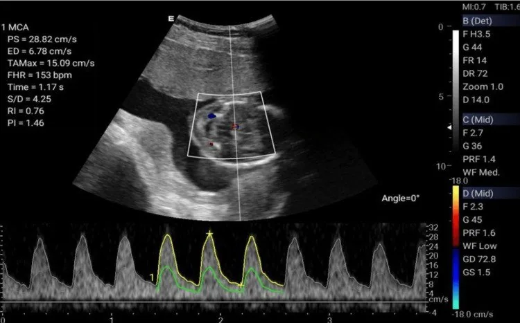Pre-eclampsia – Ultrasound: Insonation and waveform of the fetal middle cerebral artery during pre-eclampsia surveillance (Photo: Godfrey MR, Atwiine F, Atukunda EC, Celi LA, Mwavu R, Kaggwa F, Haberer JE, Wasswa …