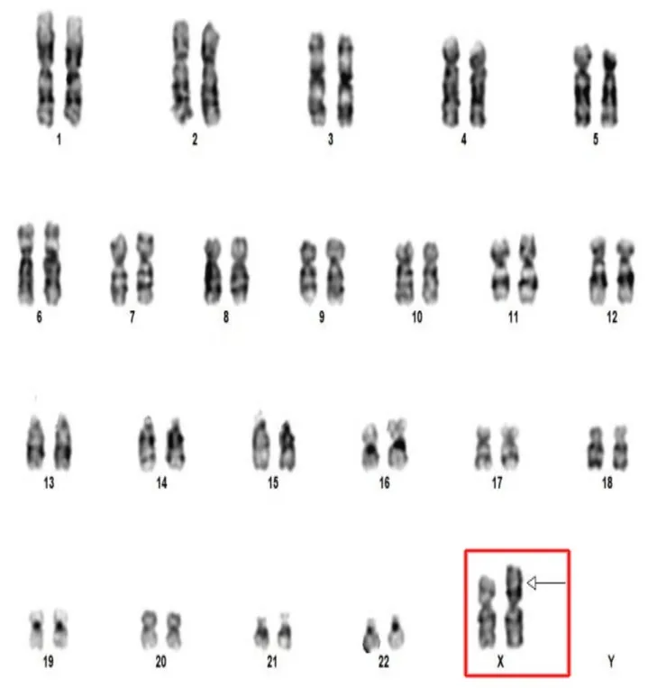 Prämature Ovarialinsuffizienz (POI) – Histologie & Zytologie: Karyogramm (G-Bänderung): Turner-Syndrom-Variante 46,X,i(X)(q10) – ein normales X und ein Isochromosom des langen X-Arms (rot umrandet, Pfeil); chromosomale Ursache der prämaturen …