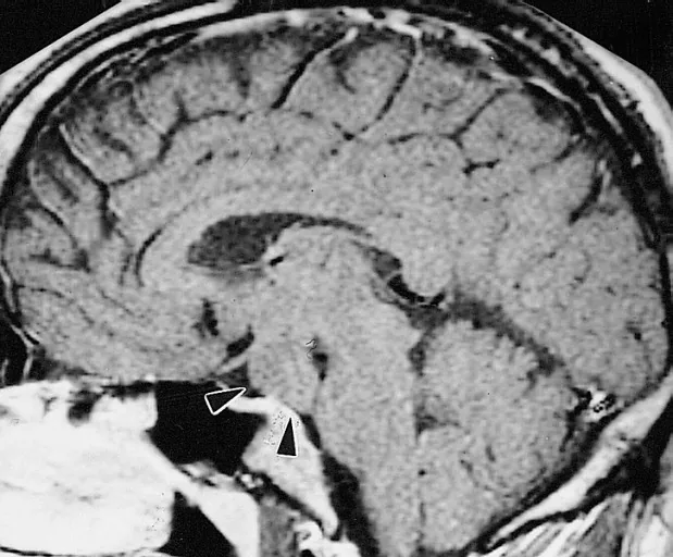 Precocious and delayed puberty – Mammography/MRI: MRI (T1, sagittal): hypothalamic hamartoma (arrowheads) at the floor of the third ventricle – a typical cause of central precocious puberty