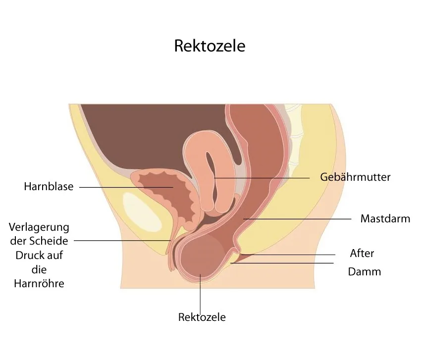 Rektozele und Enterozele – Schema: Schema (Sagittalschnitt): Rektozele – Vorwölbung der Rektumvorderwand durch das geschwächte Septum rectovaginale in die hintere Scheidenwand