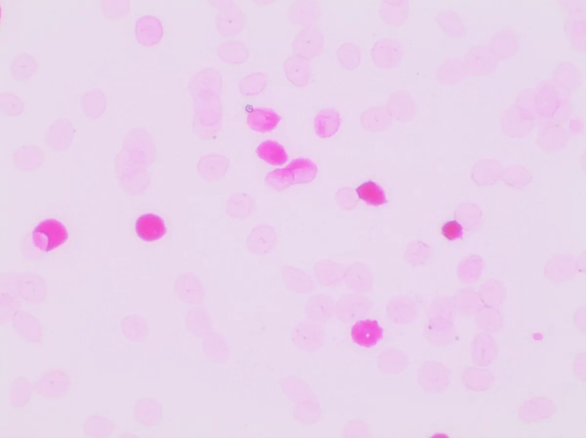 Rhesus incompatibility and fetal anaemia – Histology & cytology: Microscopy (Kleihauer–Betke test): deeply pink-stained fetal red cells among pale maternal ghost cells in fetomaternal haemorrhage