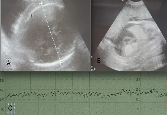 Rhesus incompatibility and fetal anaemia – Ultrasound: Ultrasound and CTG in severe Rh alloimmunisation: scalp oedema (A), marked fetal ascites (B), sinusoidal CTG pattern (C)