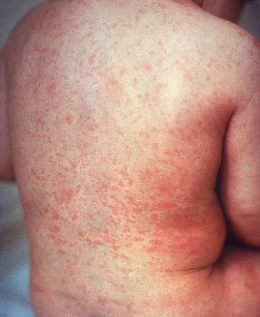 Röteln in der Schwangerschaft – Klinik: Klinisches Foto: Rötelnexanthem – feinfleckiges, blassrosa makulopapulöses Exanthem am Rücken eines Kindes
