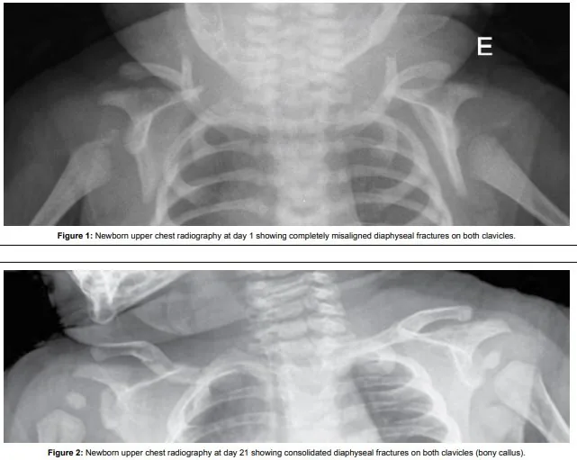Shoulder dystocia – Mammography/MRI: Radiograph: bilateral clavicular fracture as a complication of shoulder dystocia