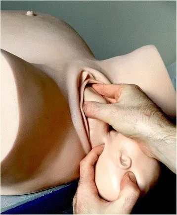 Shoulder dystocia – Clinical: Delivery of the posterior arm on a birth simulator: index and middle finger are introduced on the side of the fetal face