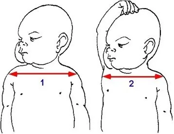 Shoulder dystocia – Diagram: Why delivering the posterior arm works: the bisacromial diameter is reduced to the acromio-thoracic diameter
