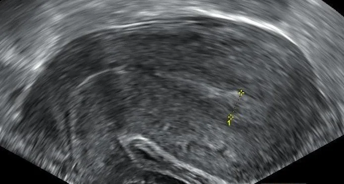 Pregnancy of unknown location (PUL) – Ultrasound: An empty cavity after complete miscarriage: no gestational sac left, endometrium 7 mm