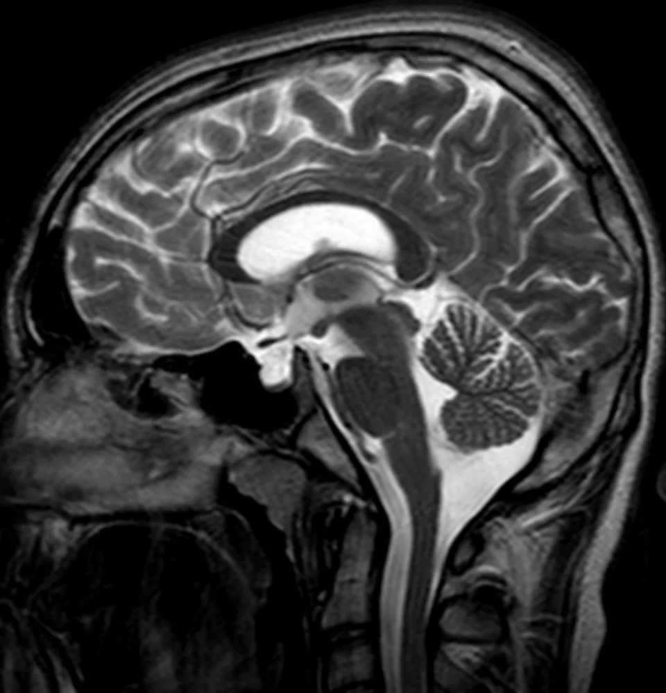 Sheehan syndrome – Mammography/MRI: MRI (T2, sagittal): empty sella – the sella turcica is filled with CSF (bright), no discernible pituitary tissue; typical late finding after pituitary necrosis (here an incidental finding)