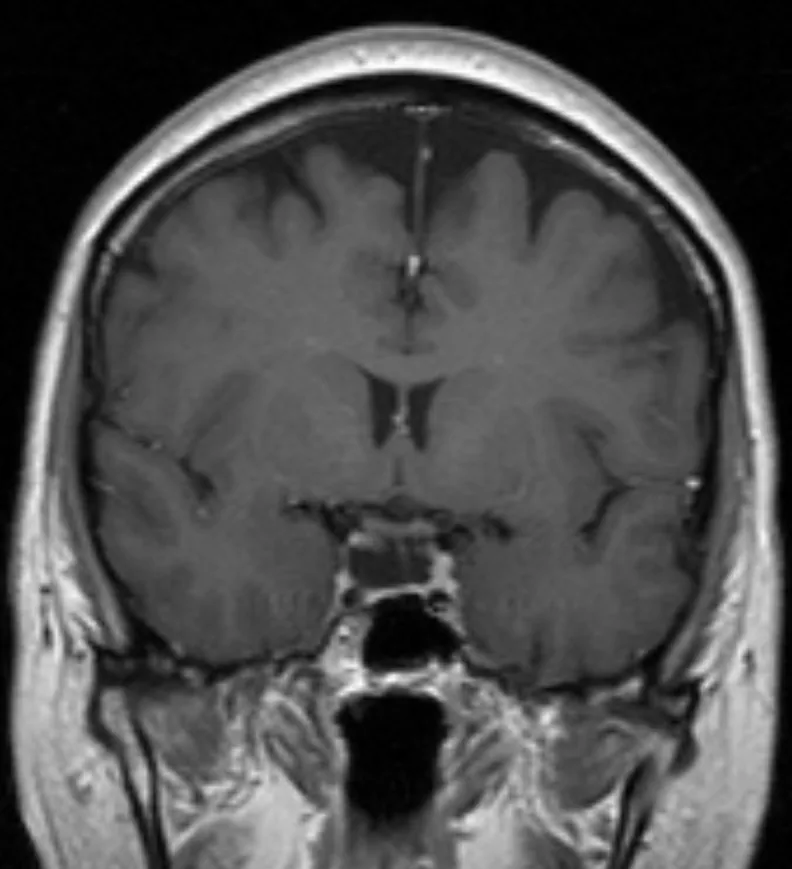 Sheehan syndrome – Mammography/MRI: MRI (contrast-enhanced T1, coronal): empty sella – sella with CSF-isointense (dark) content, pituitary reduced to a thin rim on the sellar floor (here an incidental finding)