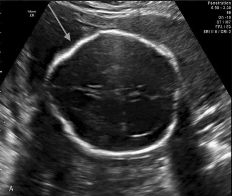 Spina bifida (Neuralrohrdefekt) – Sonographie: Lemon-Zeichen: zitronenförmige Schädelkontur durch Einziehung der Stirnbeine bei offener Spina bifida (Foto: Cavalheiro S, da Costa MDS, Mendonça JN, Dastoli PA, Suriano IC, Barbosa MM, …