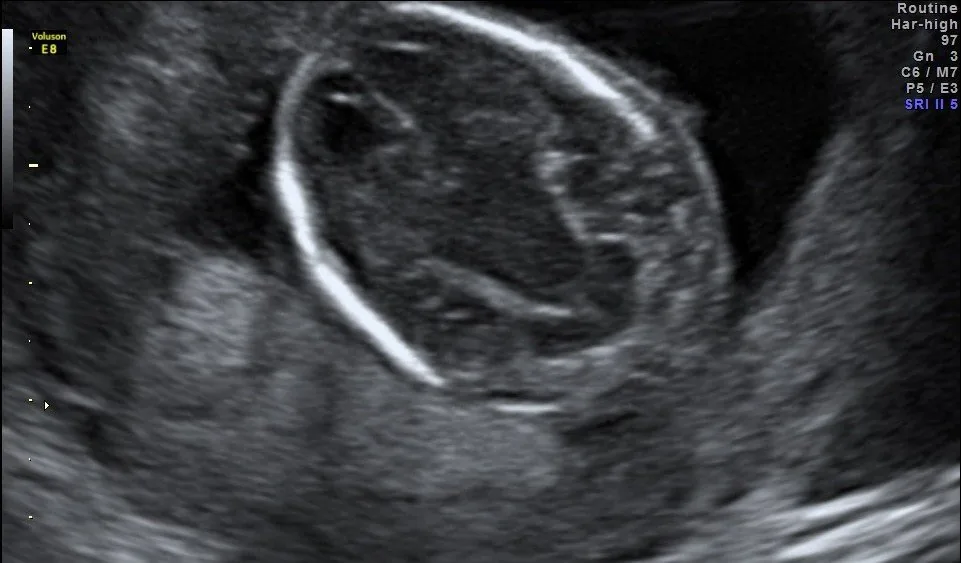 Spina bifida (Neuralrohrdefekt) – Sonographie: Banana-Zeichen in 16+2 SSW: bananenförmig verformtes Kleinhirn mit aufgehobener Cisterna magna