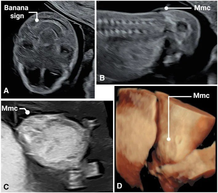 Spina bifida (Neuralrohrdefekt) – Sonographie: Myelomeningozele in 13+3 SSW — Banana-Zeichen sowie Längs-, Quer- und 3D-Darstellung des Defekts (Foto: Shwartz T, Cohen SM, Lipschuetz M, Hochler H, Zalel Y, Valsky DV, Yagel S. …