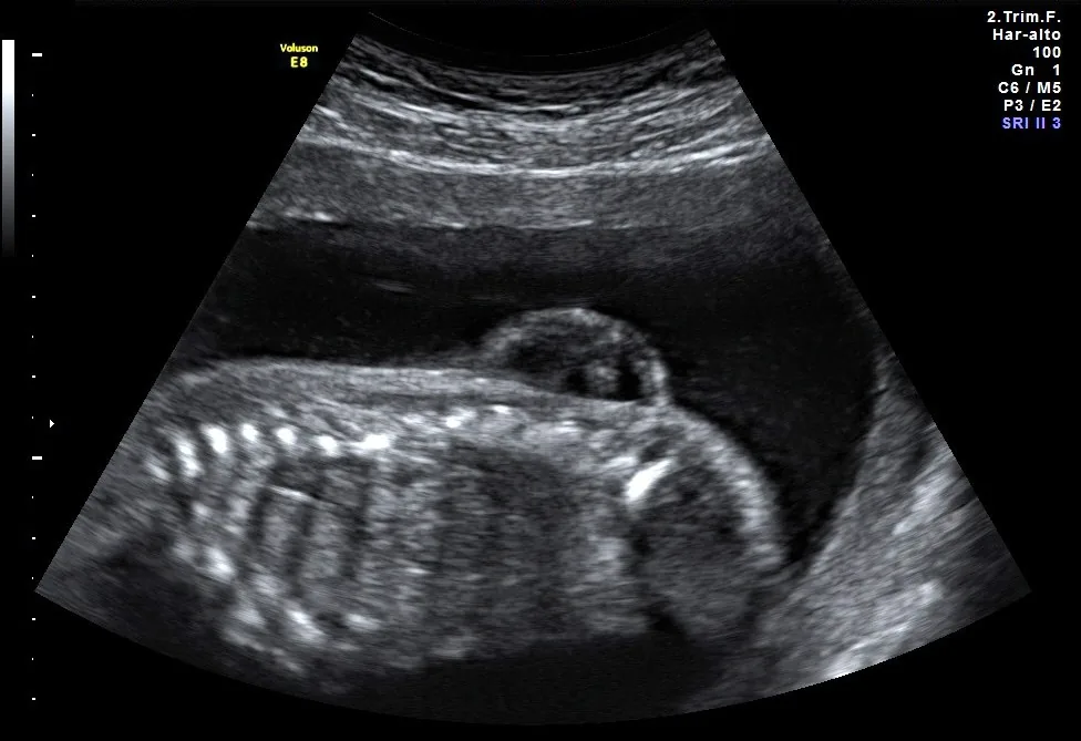 Spina bifida (Neuralrohrdefekt) – Sonographie: Lumbale Myelomeningozele im Längsschnitt (21+5 SSW)