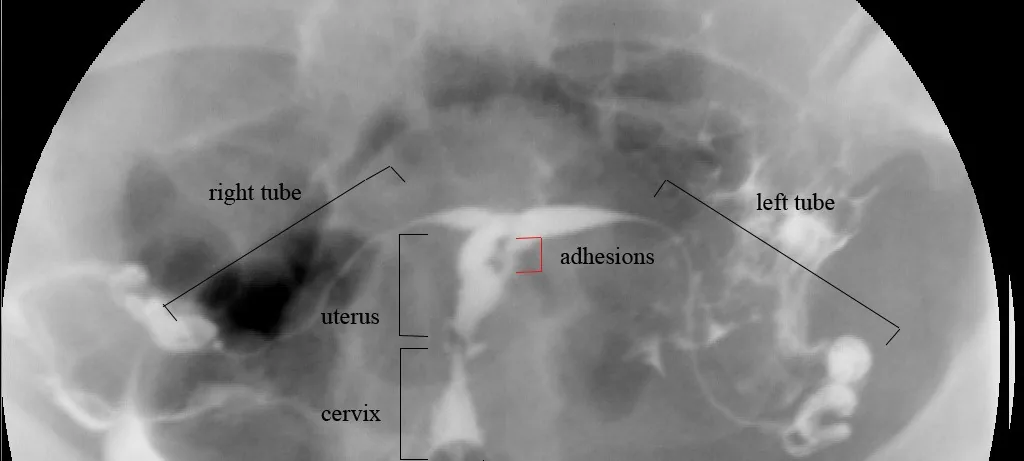 Sterilität der Frau – Mammographie/MRT: Hysterosalpingographie: intrauterine Adhäsionen (Asherman-Syndrom) als Füllungsdefekt im Cavum uteri (rote Klammer), beide Tuben dargestellt