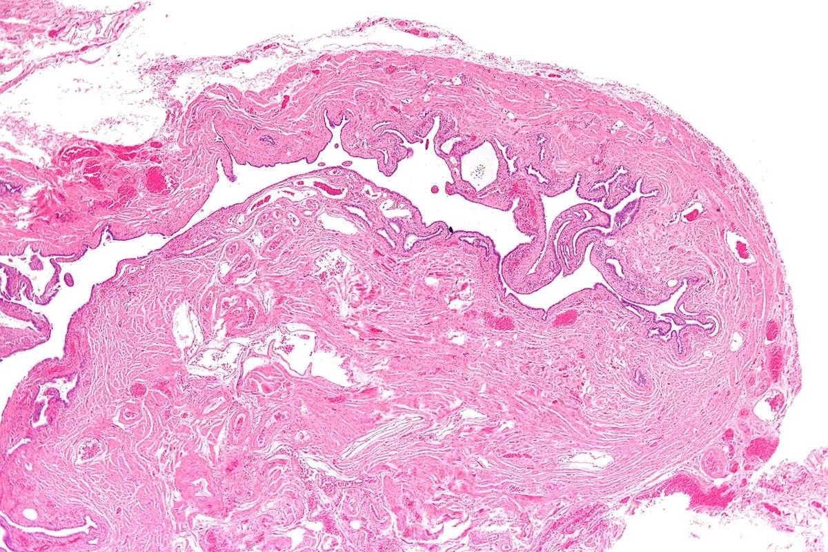 Sterilität der Frau – Histologie & Zytologie: Histologie (HE): Salpingitis isthmica nodosa – knotige Verdickung des Tubenisthmus mit divertikelartigen Epithelgängen in der Muskelwand, tubarer Sterilitätsfaktor