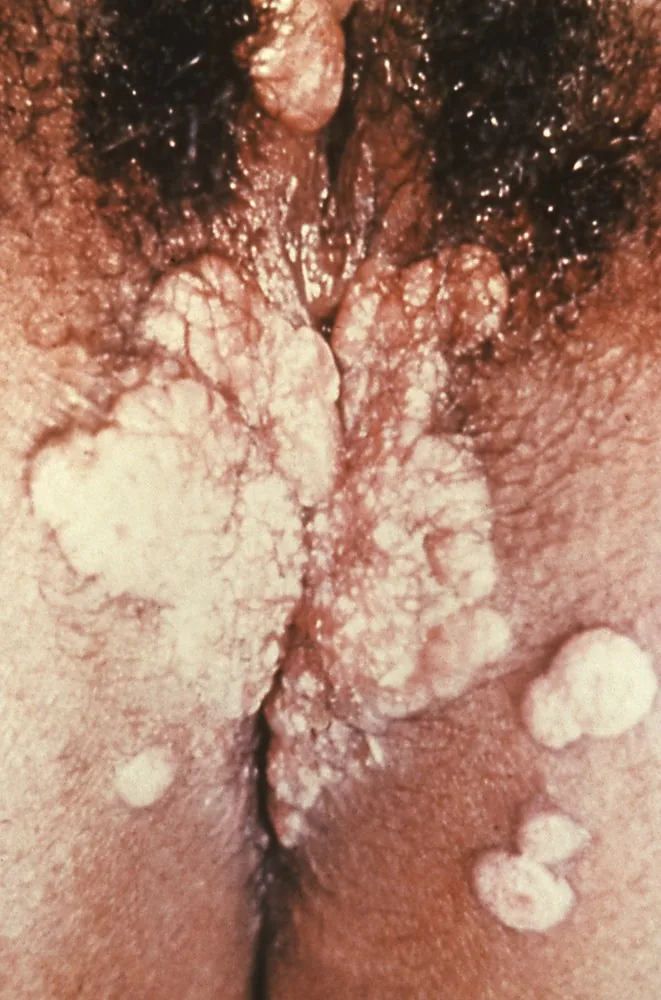 Syphilis in Gynäkologie und Schwangerschaft – Klinik: Condylomata lata bei Lues II