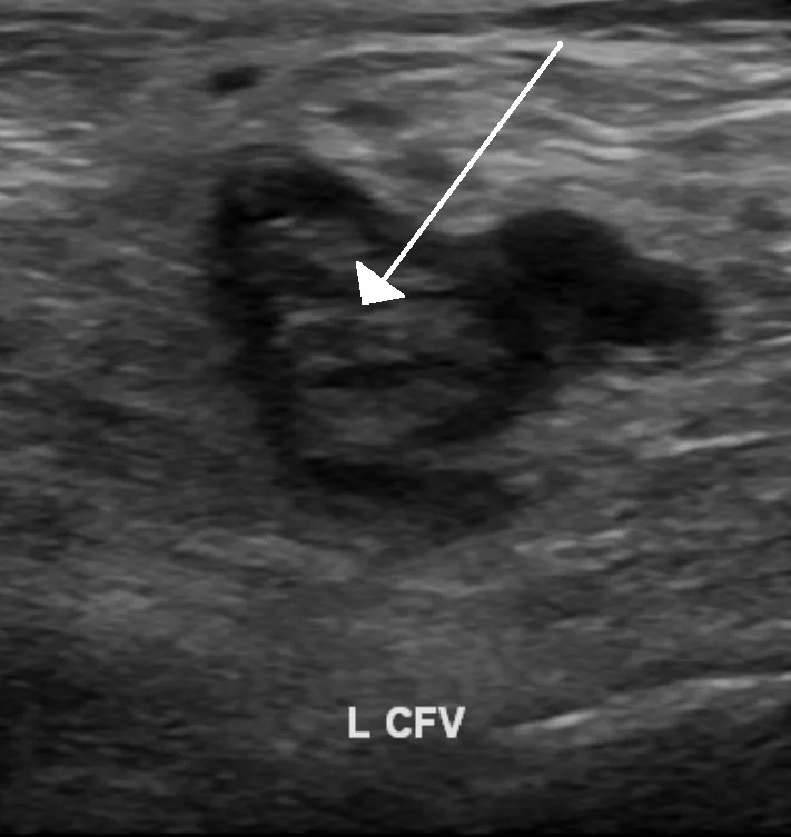 Thrombose und Lungenembolie in Schwangerschaft und Wochenbett – Sonographie: Sonographie (Querschnitt): echogener Thrombus in der linken V. femoralis communis (Pfeil) – tiefe Beinvenenthrombose
