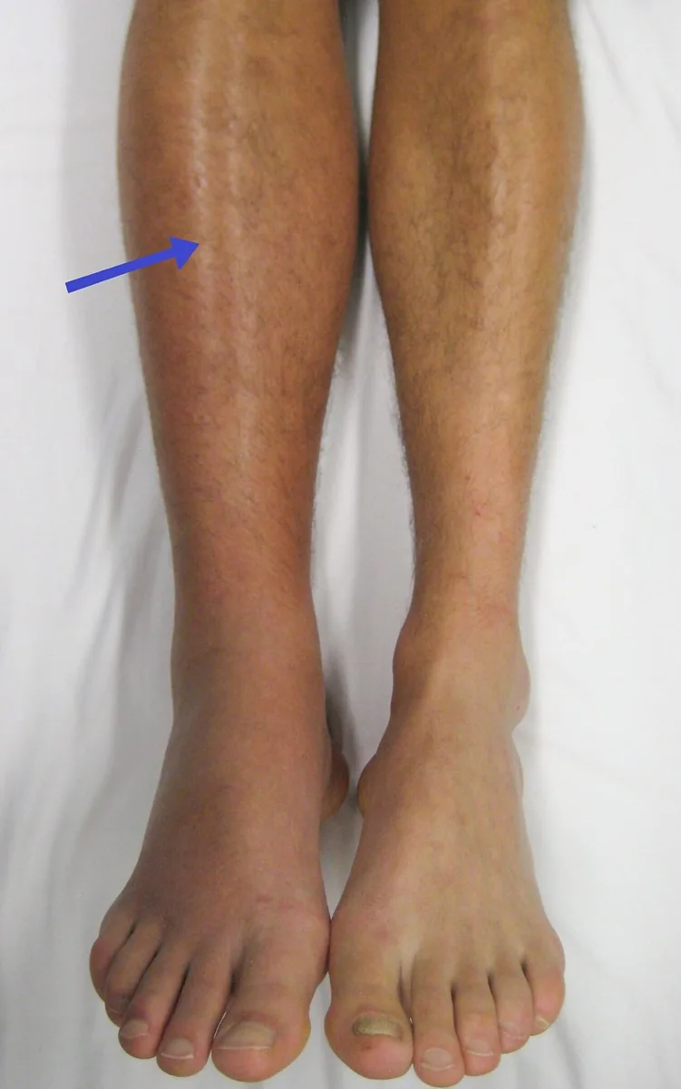 Thrombose und Lungenembolie in Schwangerschaft und Wochenbett – Klinik: Klinisches Foto: tiefe Beinvenenthrombose rechts – Schwellung und Rötung des rechten Unterschenkels (Pfeil) im Seitenvergleich