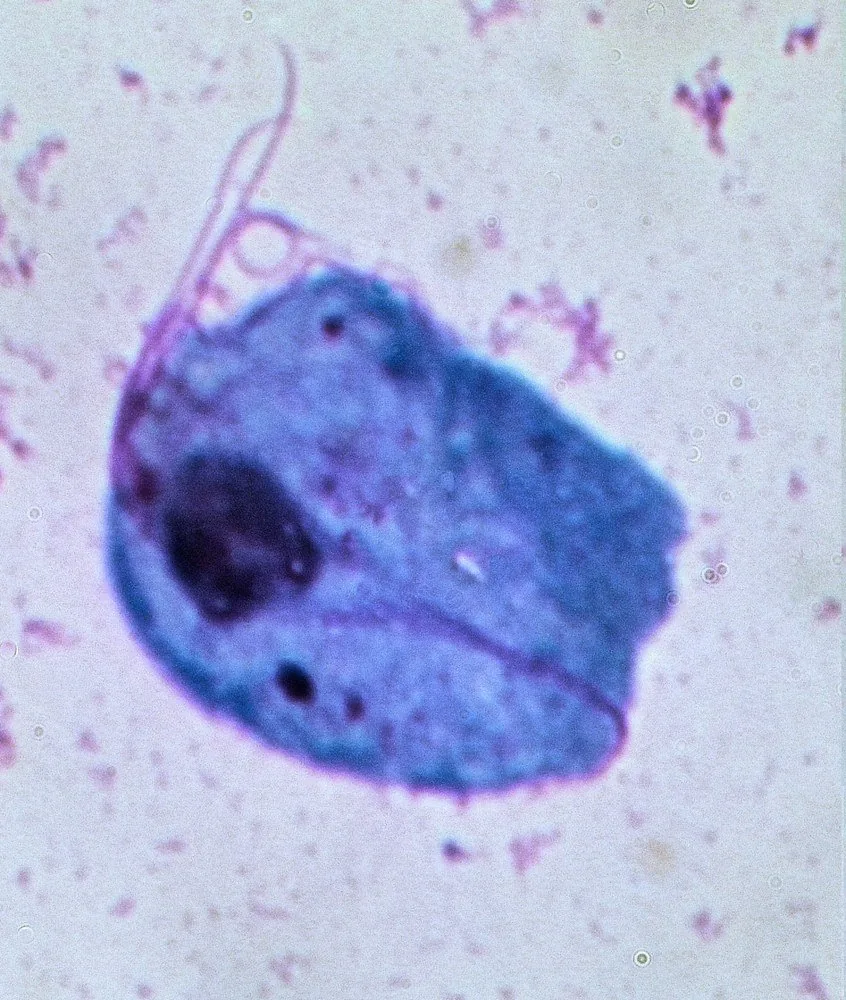 Trichomoniasis – Histology & cytology: Trichomonas vaginalis in May-Grünwald stain: pear-shaped protozoan with flagella and an eccentric nucleus