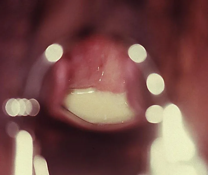 Trichomoniasis – Colposcopy: Abundant yellowish-purulent discharge below the cervix in trichomonal colpitis
