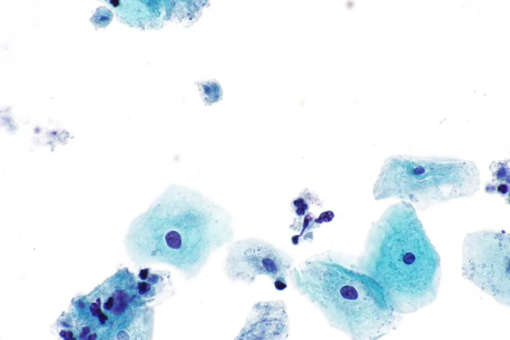 Trichomoniasis – Histology & cytology