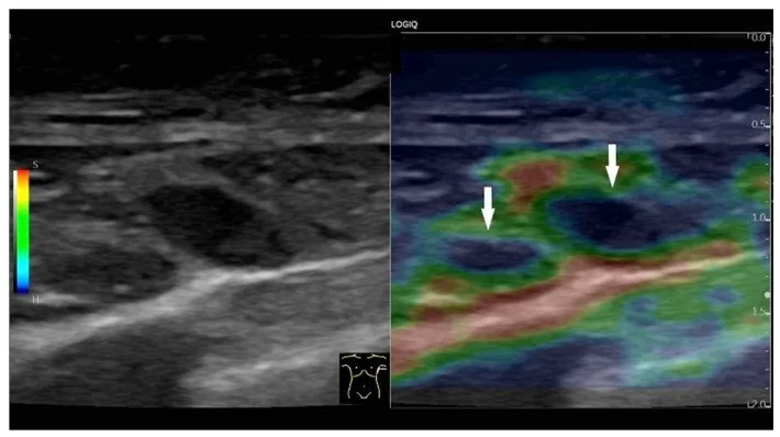 Triple-negative breast cancer – Ultrasound: Axillary lymph nodes in breast cancer: rounded, hypoechoic, with loss of the fatty hilum (elastogram on the right)