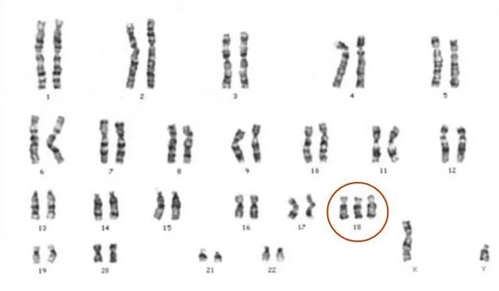 Trisomy 18 and 13 – Clinical
