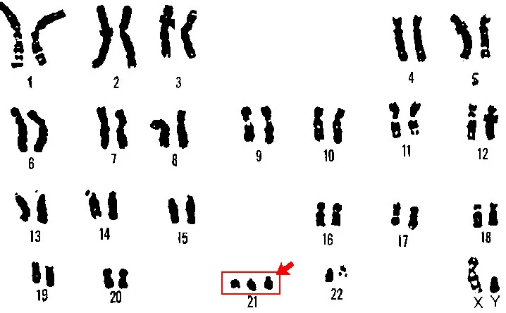 Trisomy 21 (prenatal diagnosis) – Clinical