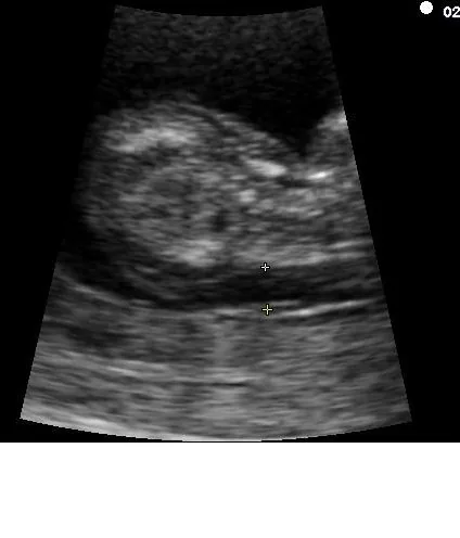 Trisomie 21 (pränatale Diagnostik) – Sonographie: Erhöhte Nackentransparenz 4,2 mm (Trisomie 21)