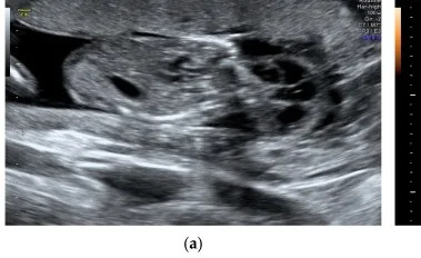 Trisomie 21 (pränatale Diagnostik) – Sonographie: Beidseitiges septiertes Hygroma colli (12+3 SSW, Trisomie 21)