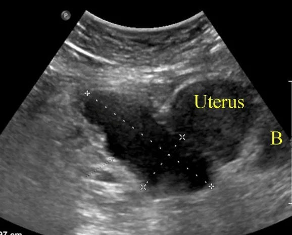 Tubo-ovarian abscess – Ultrasound: Complex cystic-solid adnexal mass — tubo-ovarian abscess