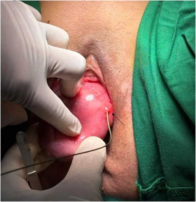 Urogenitalfisteln (vesikovaginale Fistel) – Klinik: Blasenmukosaprolaps bei obstetrischer vesikovaginaler Fistel