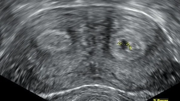 Uterine malformations (septate, bicornuate uterus) – Ultrasound