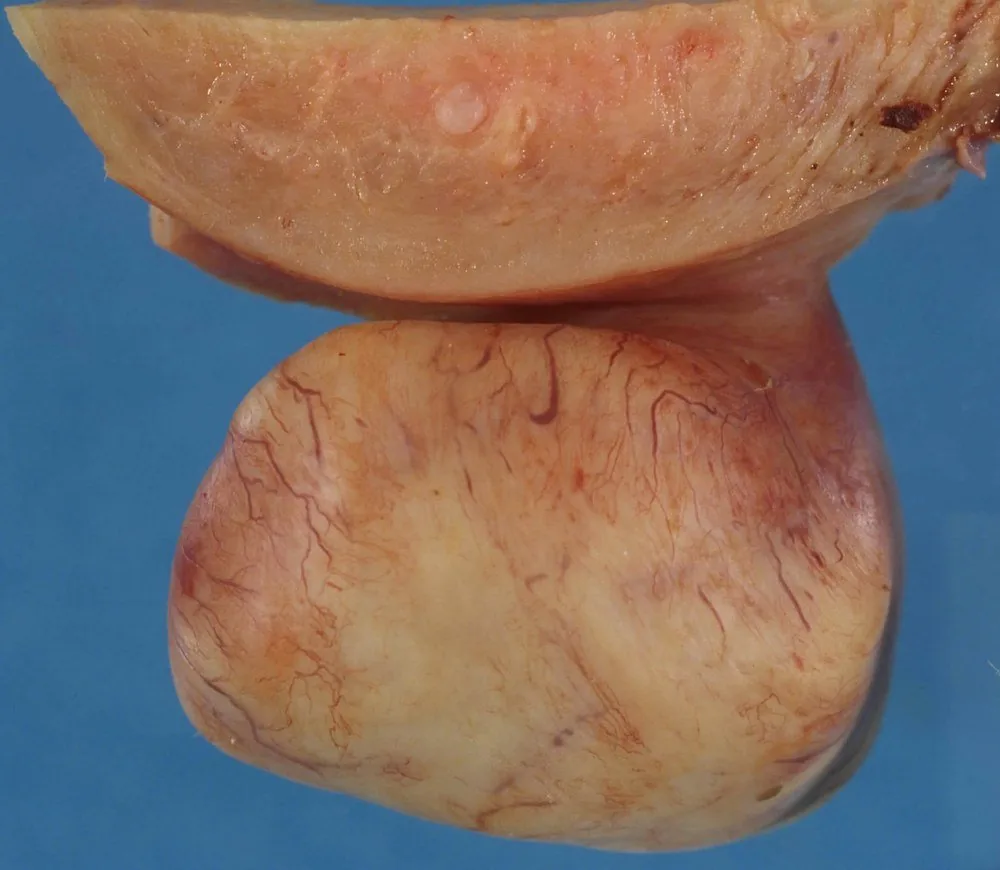 Uterusmyom (Uterus myomatosus) – Endoskopie & Makro: Makropräparat: subseröses Myom mit gut abgegrenzter, wirbeliger weißlicher Schnittfläche
