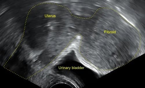 Uterusmyom (Uterus myomatosus) – Sonographie: subseröses Myom (FIGO 6–7), transvaginal
